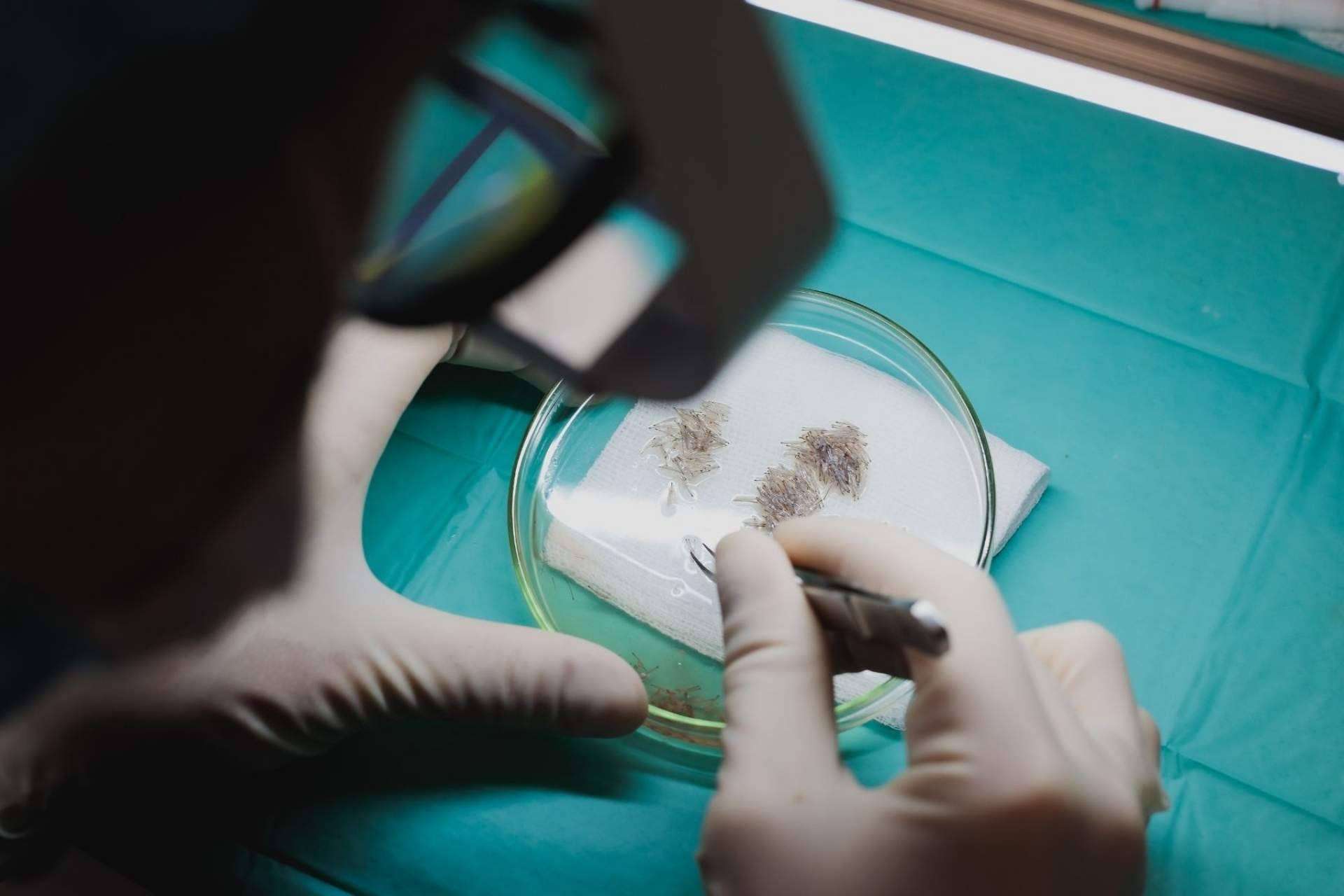 Adcure Clinic: ¿Cuáles son las claves para conseguir un buen trasplante capilar?
