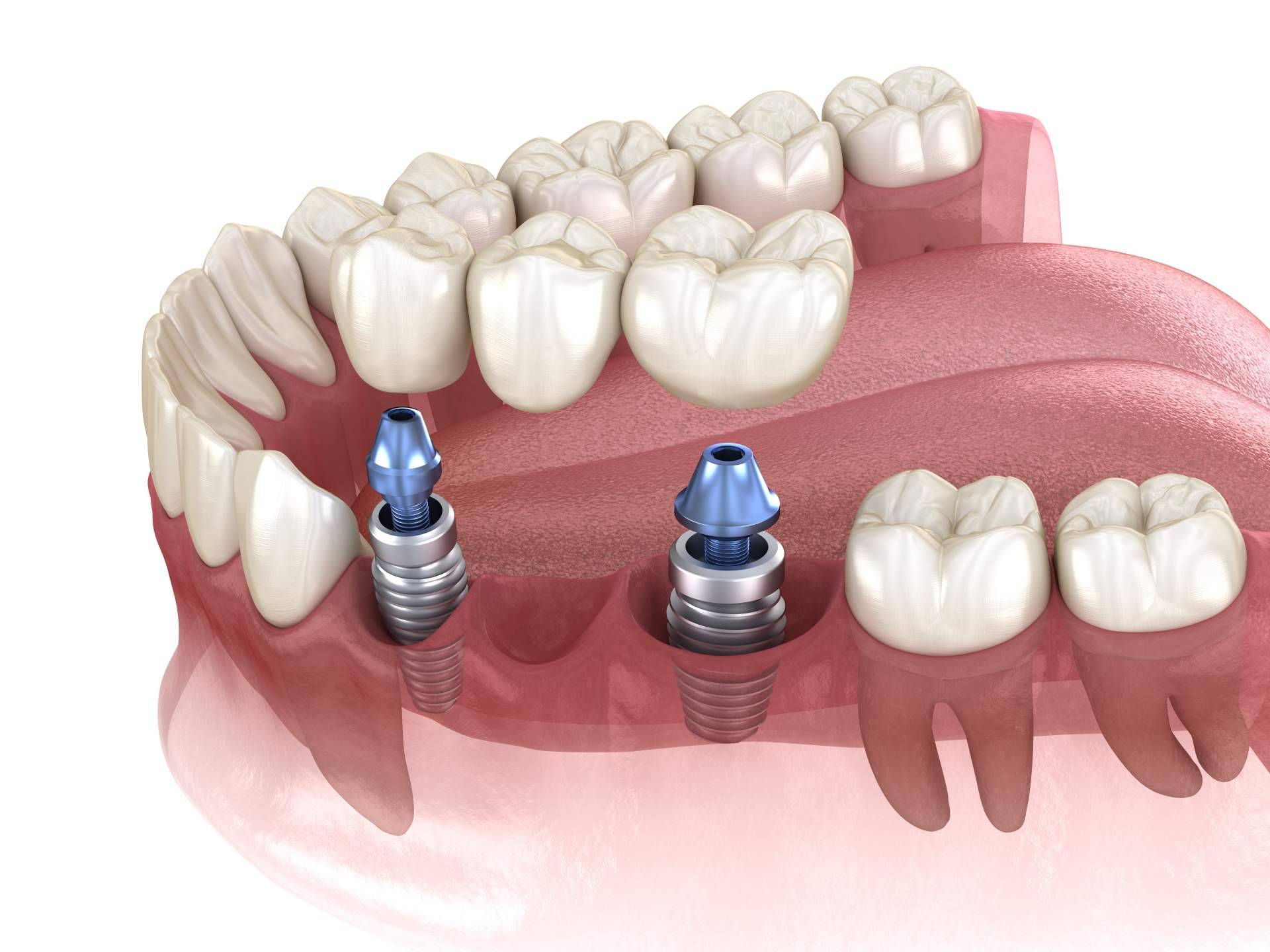 La Clínica Artydents en Madrid, reconocida por la calidad de su implante dental de titanio V