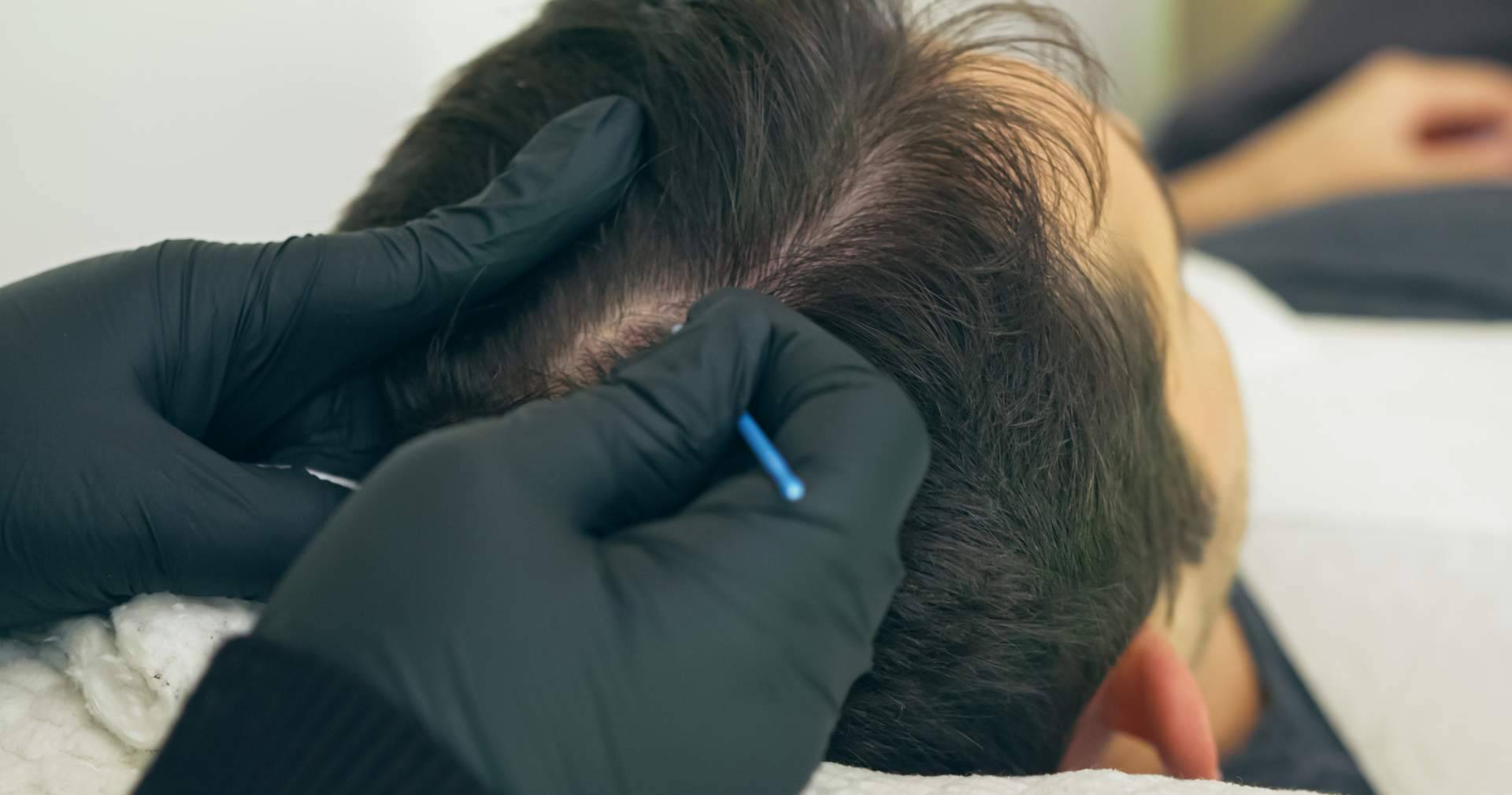Distrito Wellness Concept dispone de tratamientos de micropigmentación capilar para cubrir las zonas afectadas por la pérdida de cabello