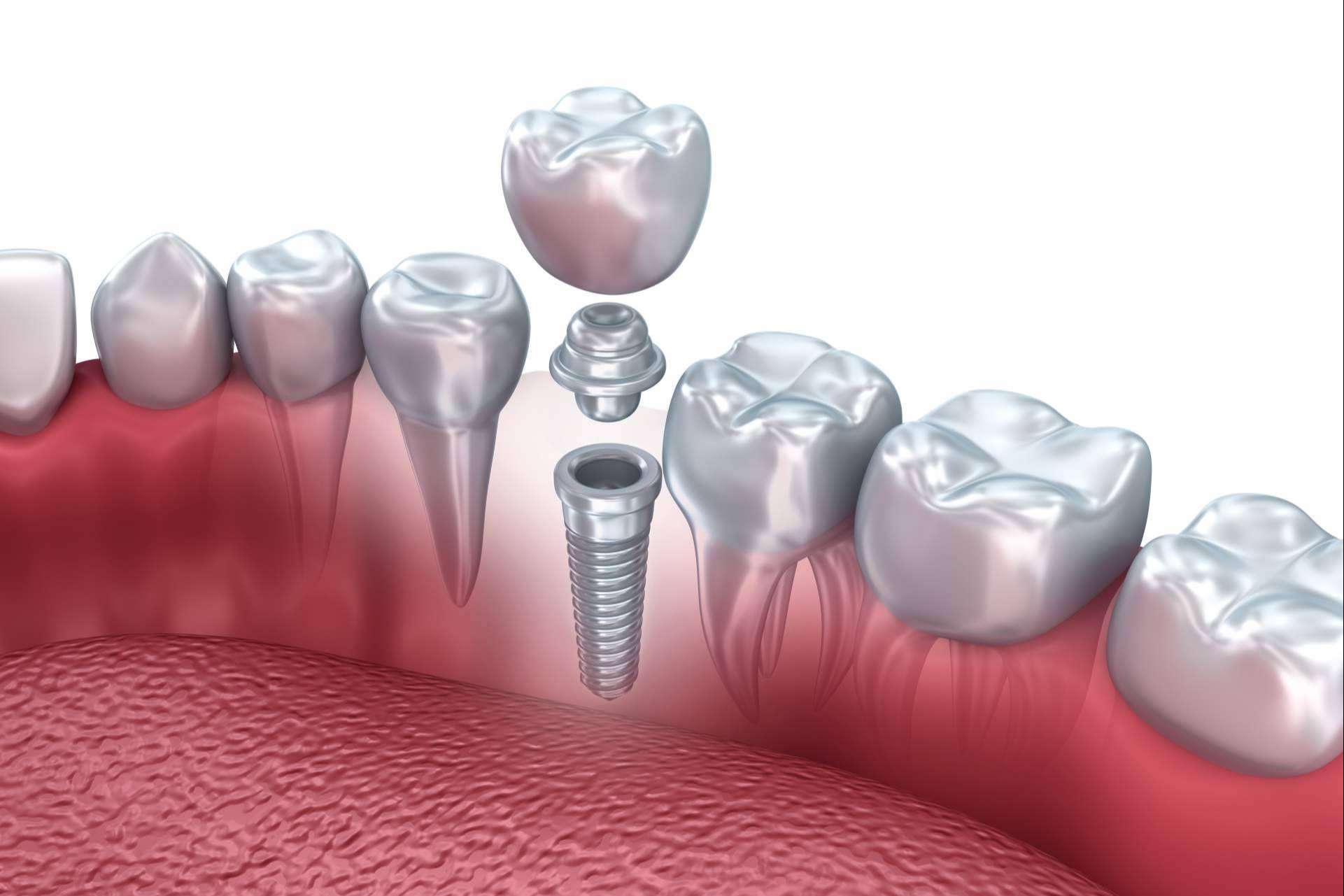 Clínica Dental Heins: ¿Cuánto cuesta un implante dental en Valladolid?