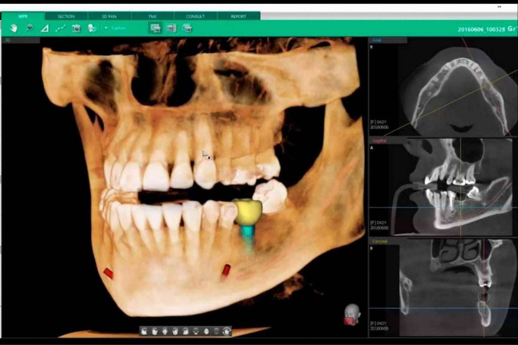 Las técnicas avanzadas en implantología: odontología digital de la mano de Clínica Blay Monzó