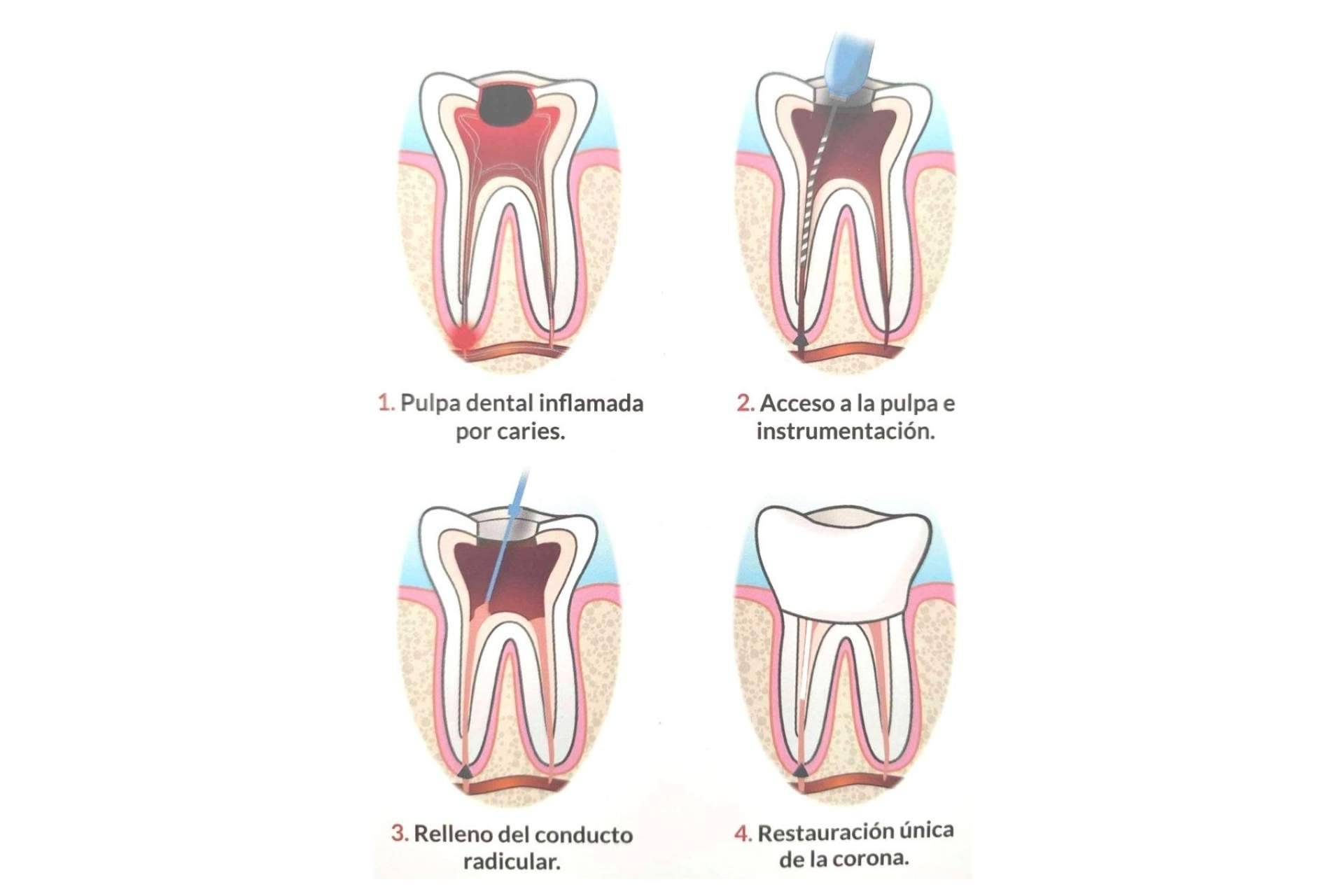 El éxito en los procedimientos de endodoncia que realiza Implant Clinics