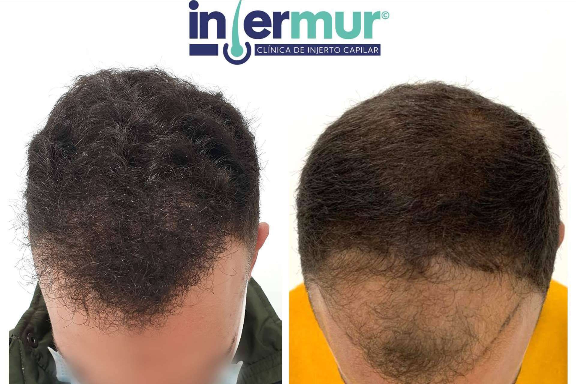 Injermur, la clínica de injerto capilar en Murcia especializada en el injerto sin cicatriz