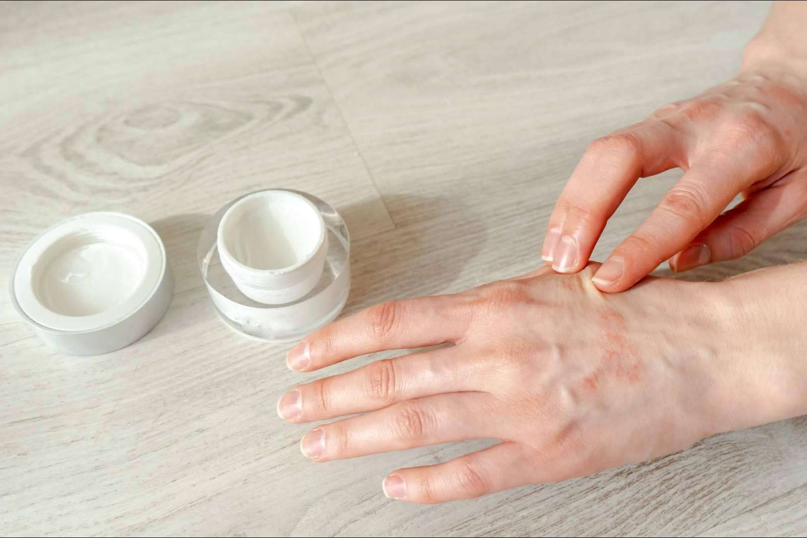 ¿Eczema de contacto o eczema atópico?, por Laboratorio Géomer