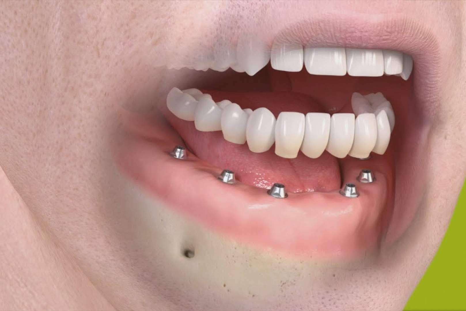 La clínica dental Bordonclinic lleva a cabo rehabilitaciones orales complejas en un día