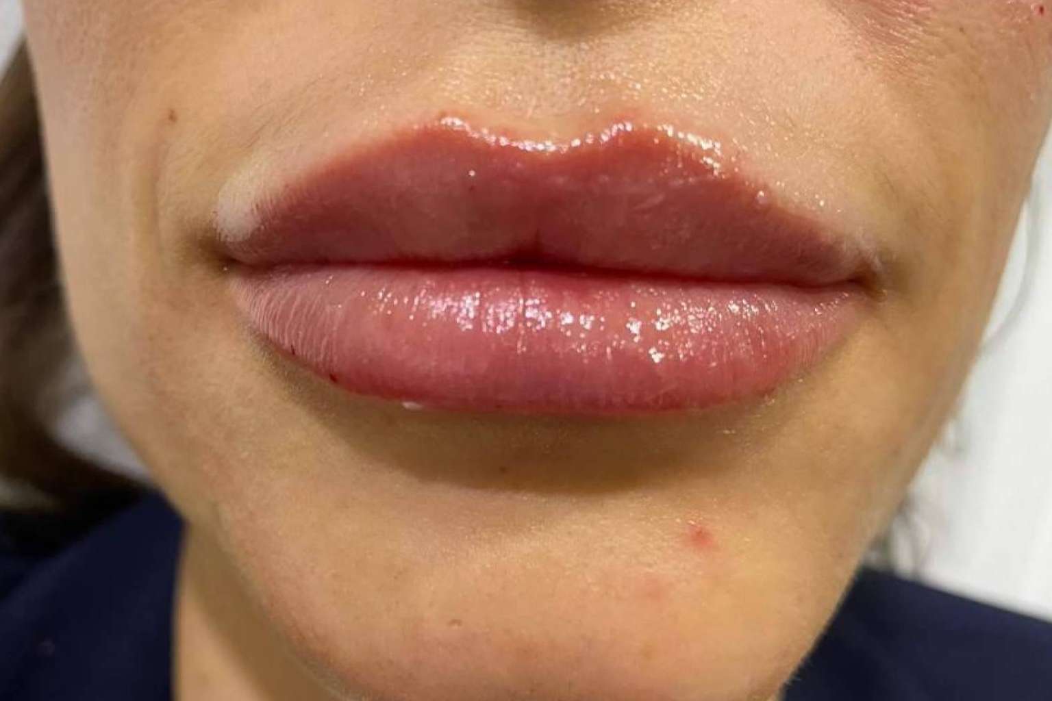 Aumento y remodelación de labios con ácido hialurónico