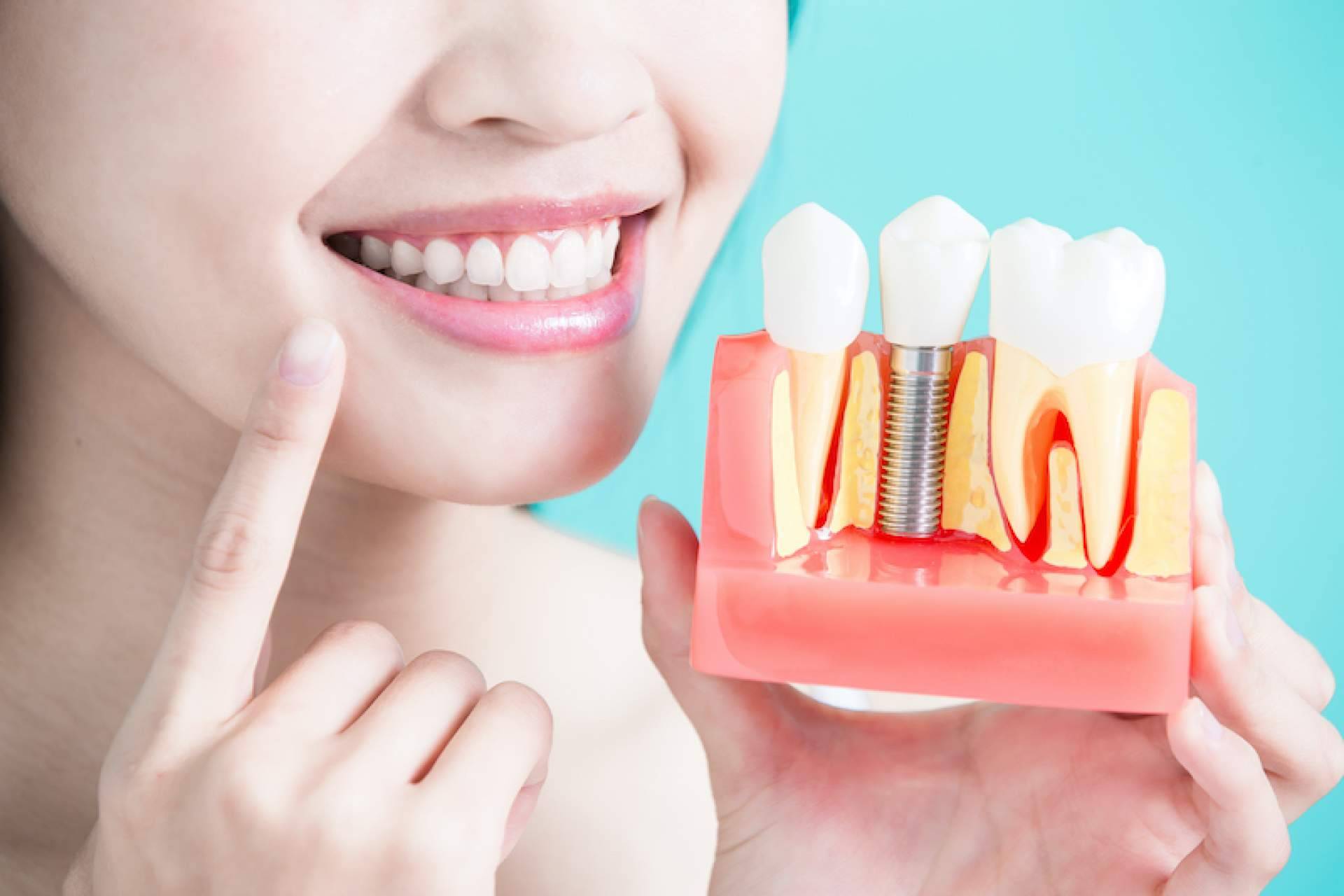 Los implantes personalizados con materiales de calidad que ofrece la clínica dental Samprodent