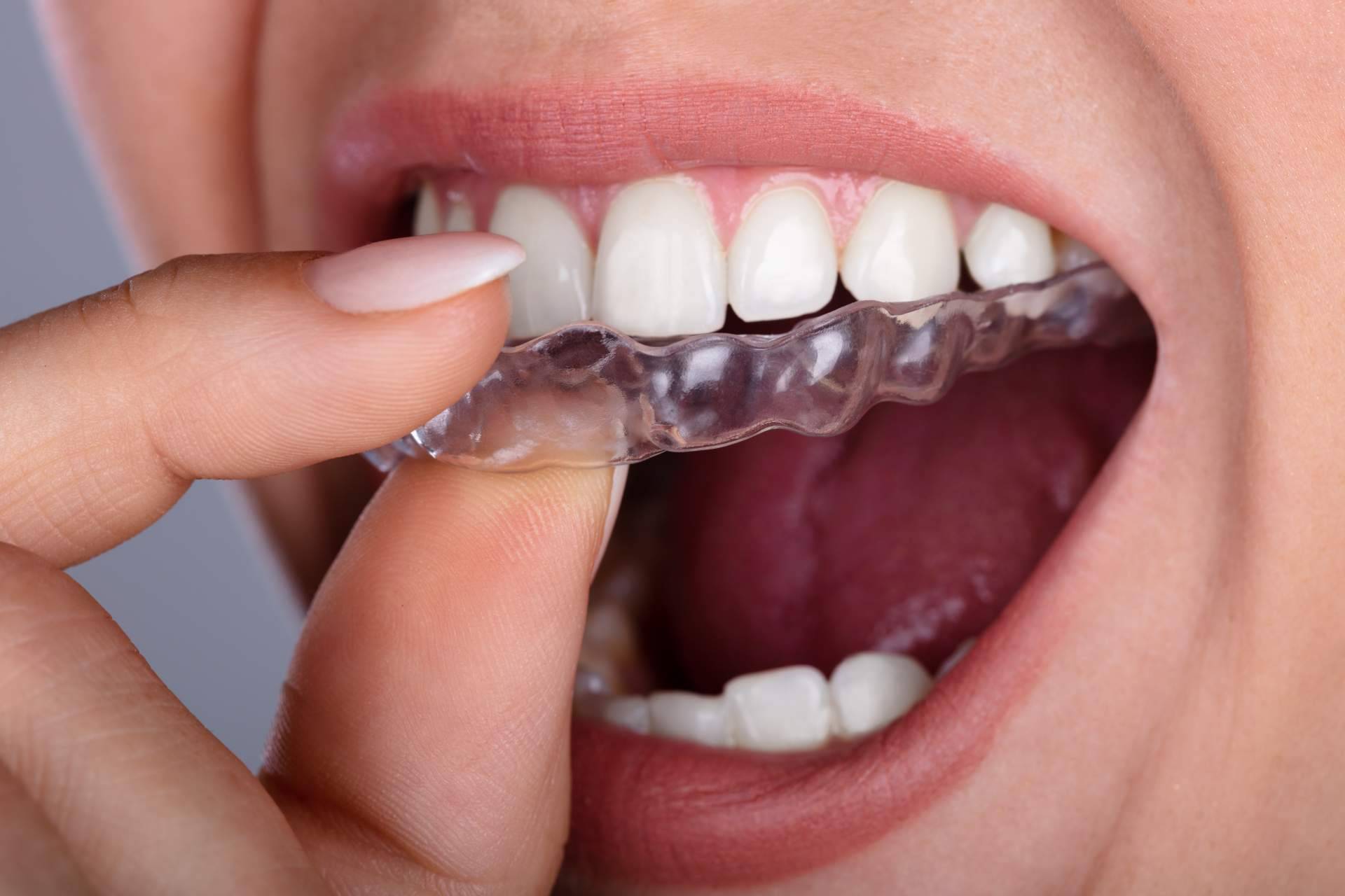 Tratamiento de ortodoncia invisible de la mano de los dentistas Alcorcón de Clínica Darío Ulman
