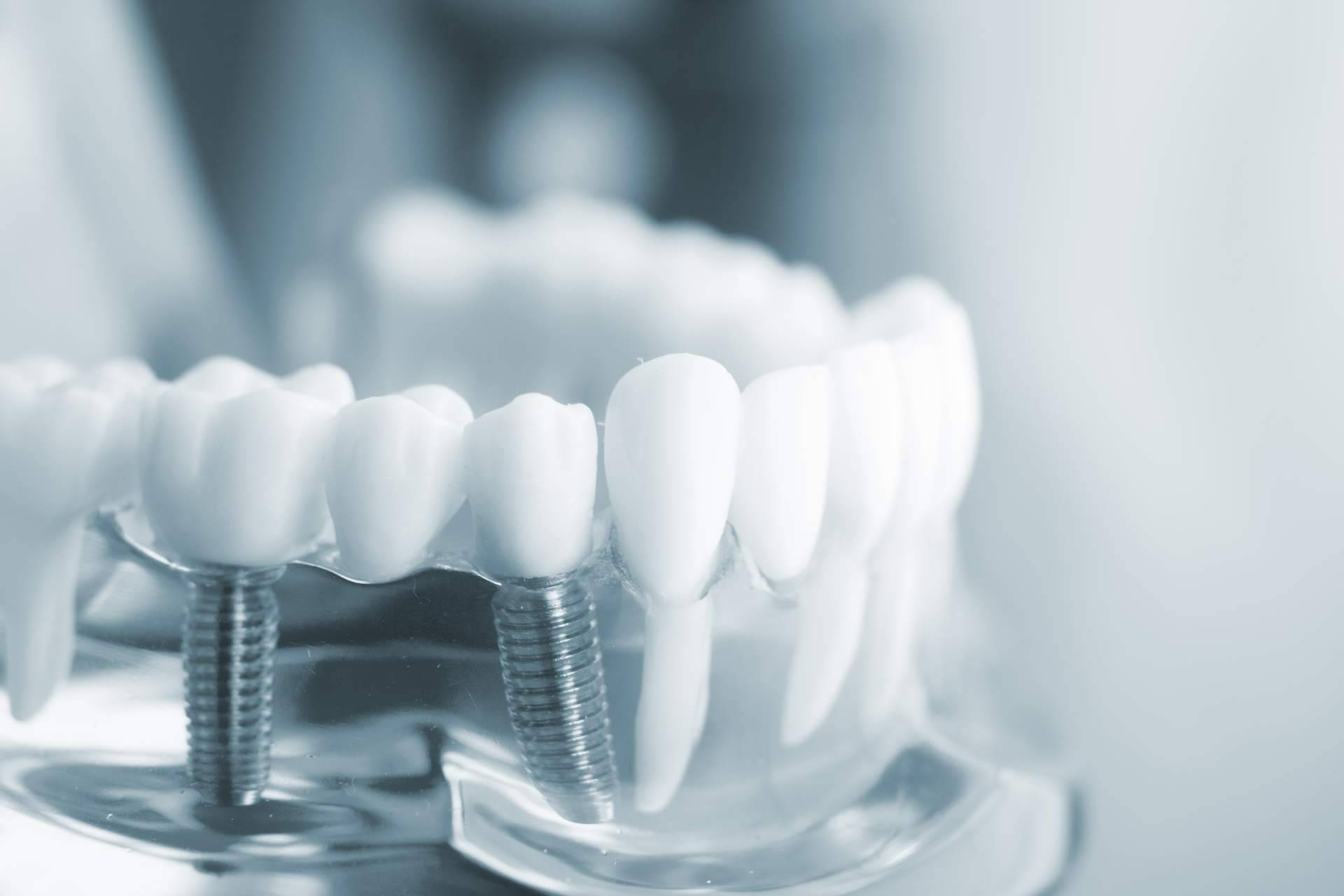 ¿Qué ventajas aportan los implantes de Zirconio? DeltaDent