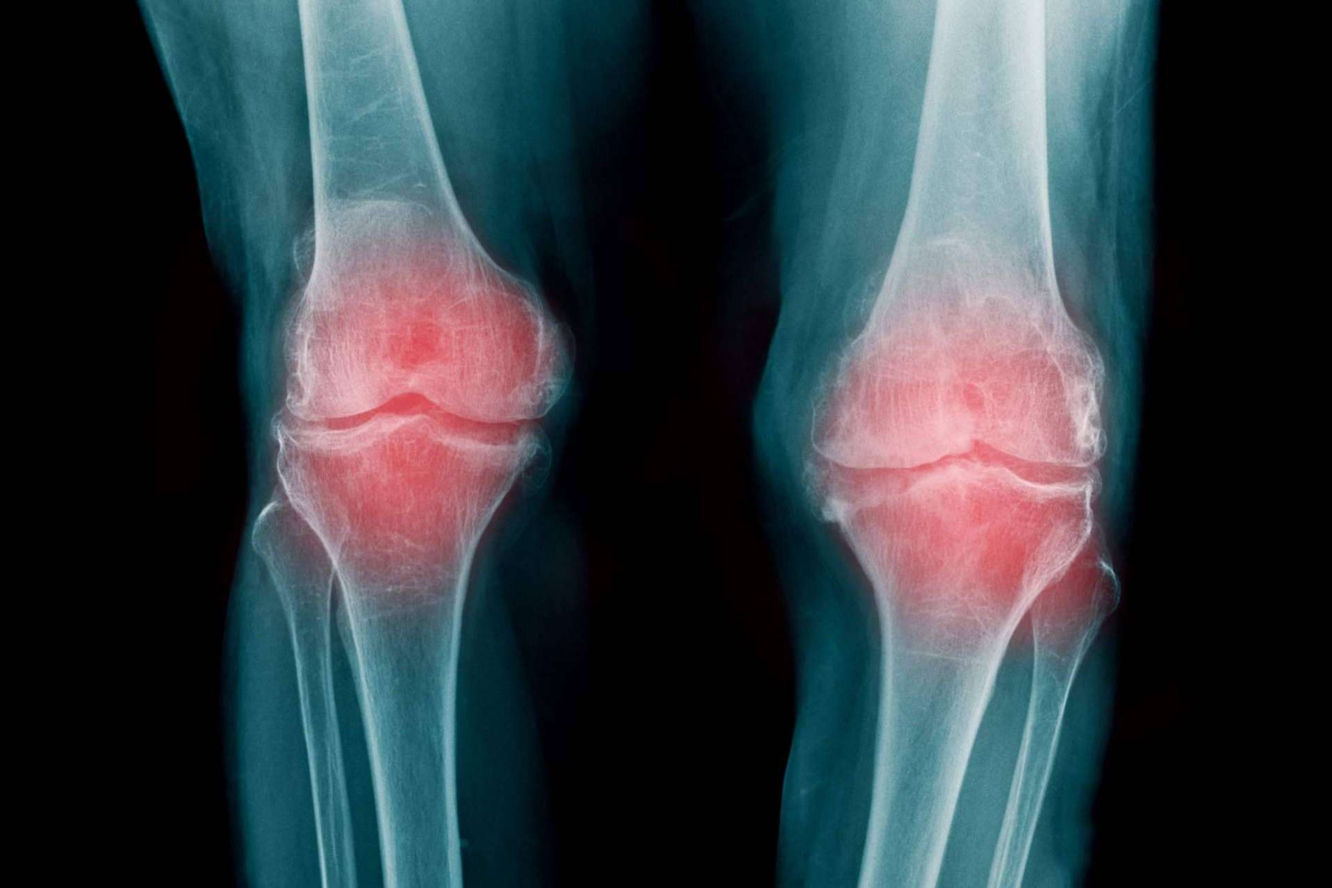 La colaboración de iXalud con la asociación de pacientes de artrosis y osteoporosis OAFI