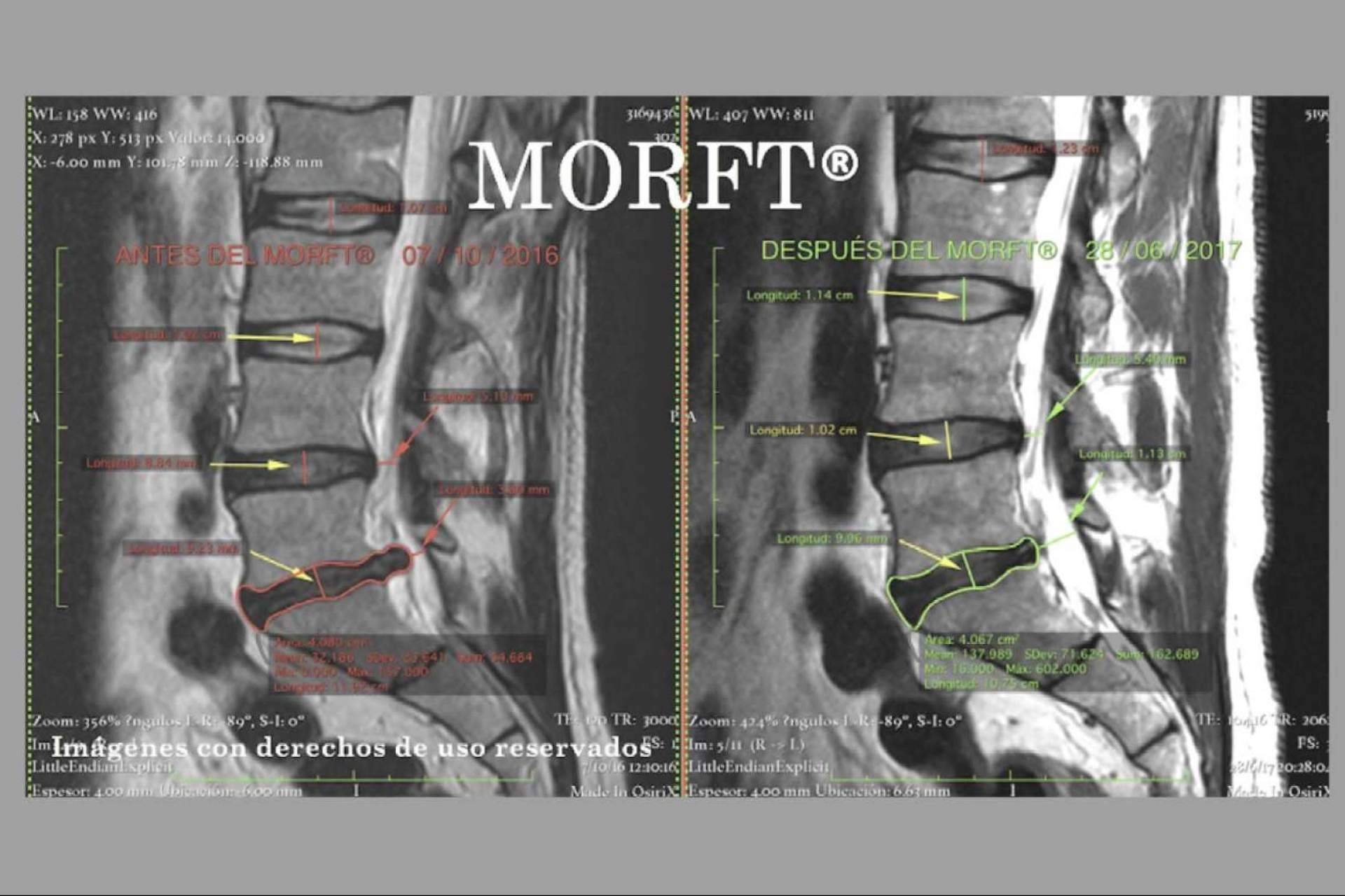 La regresión discal de las hernias con el método MORFT®