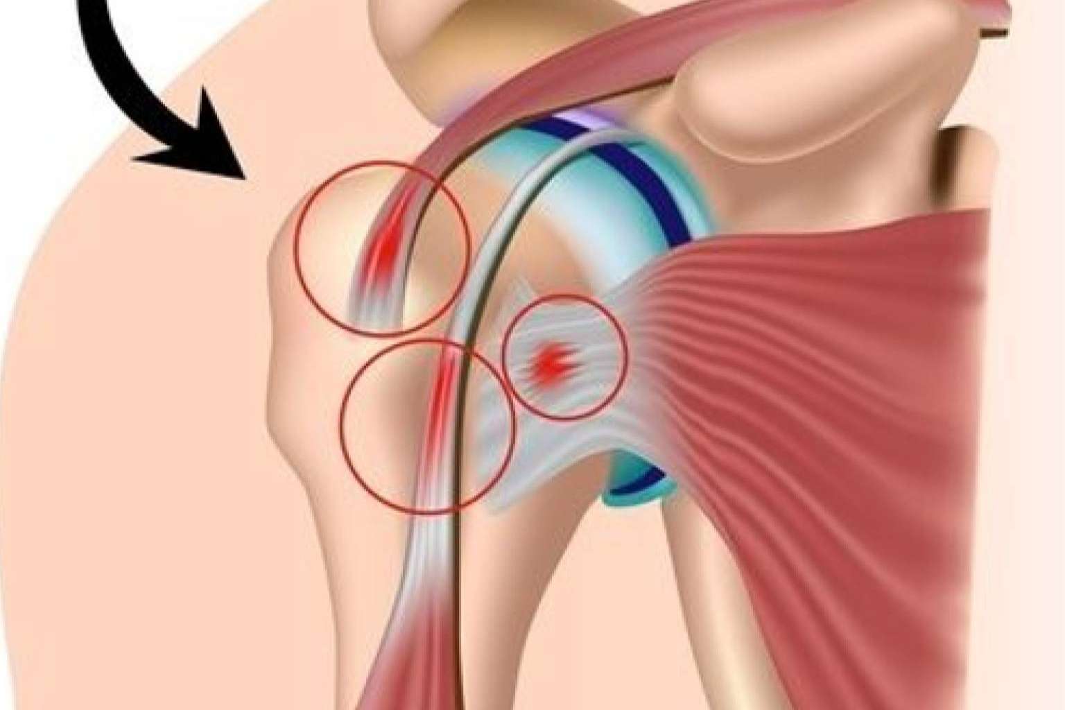 Medicina regenerativa para tratar el dolor de hombro, de la mano de Biorigenera