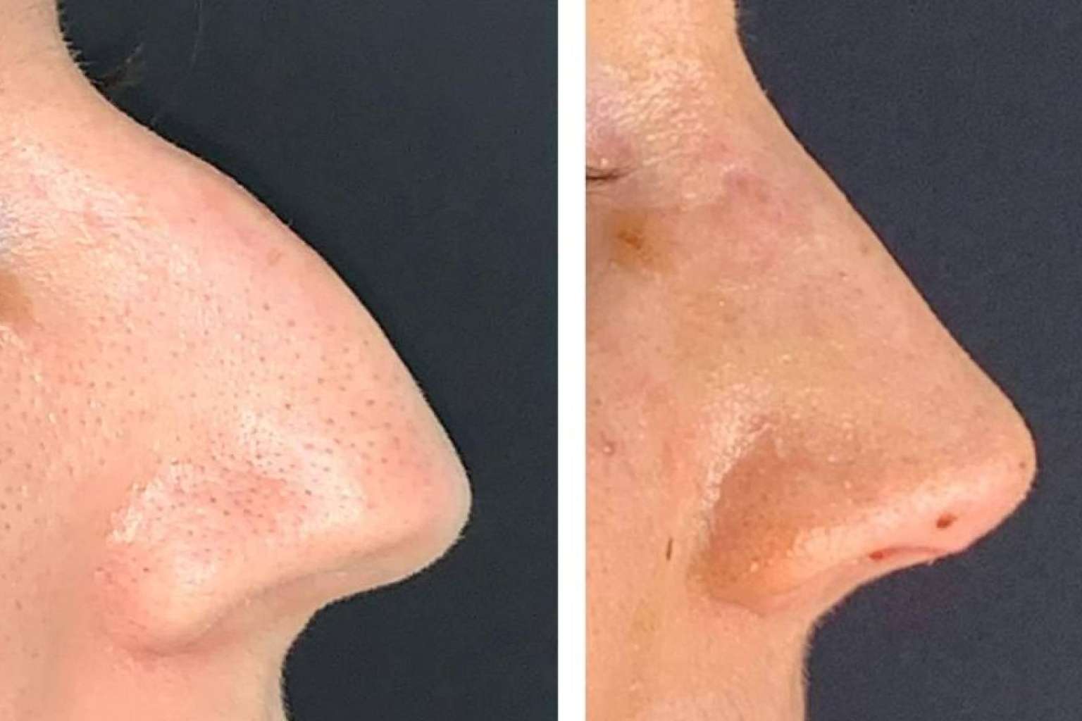 Rinoplastia ultrasónica; La Revolución en Cirugía Nasal