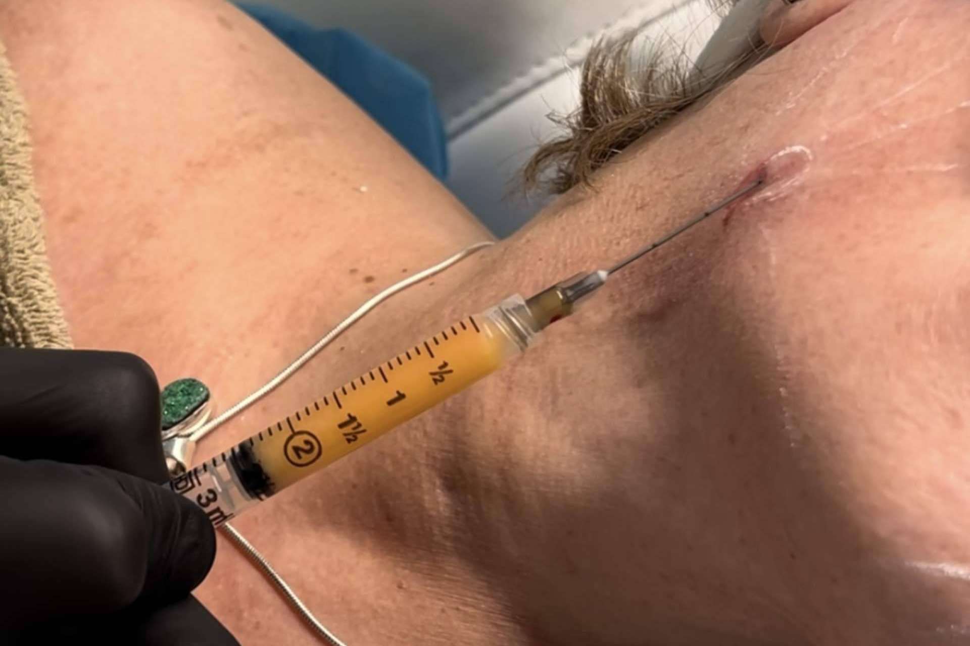 MD Cliniques presenta a SEFFILLER®️, la terapia regenerativa autóloga que transforma la medicina estética