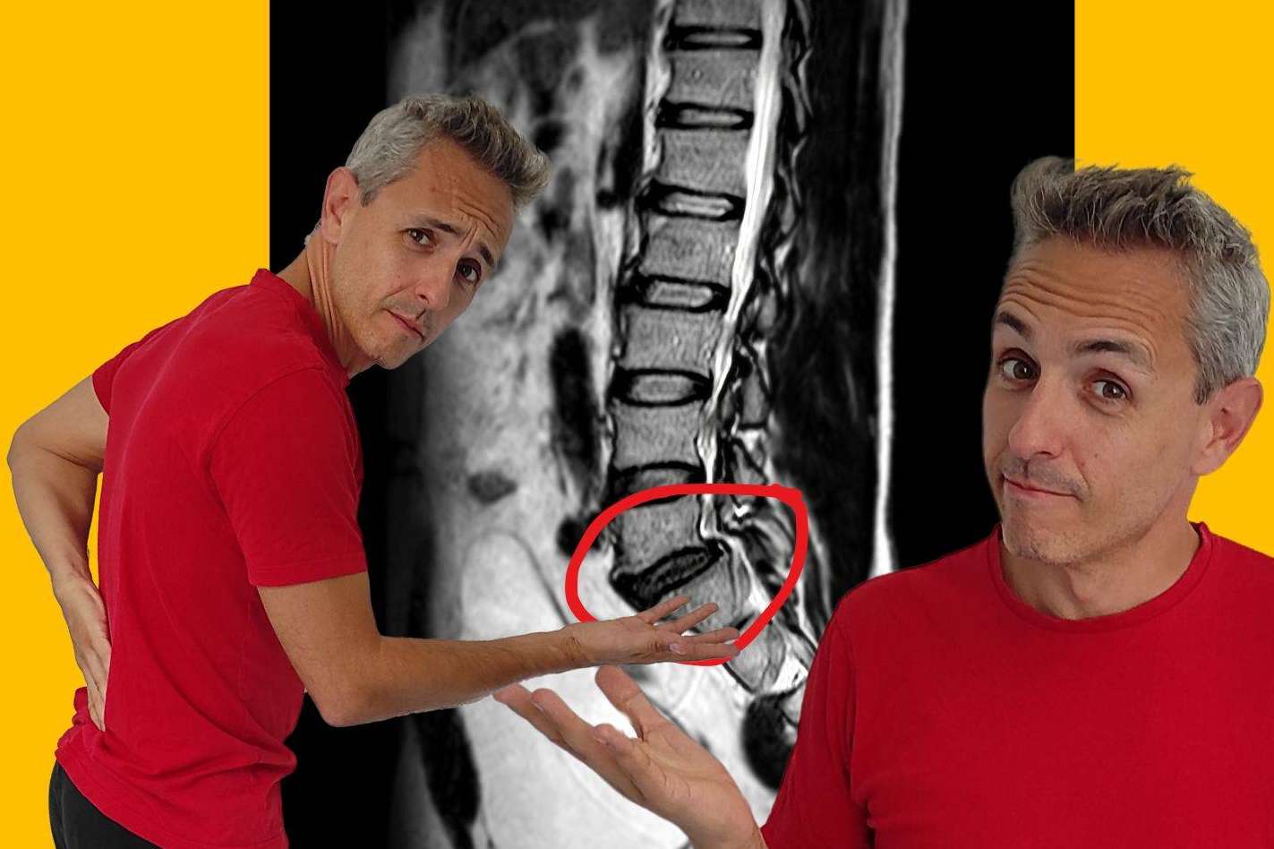 El método de Roberto Galván para ganar la batalla a las molestias derivadas de la hernia discal L5-S1