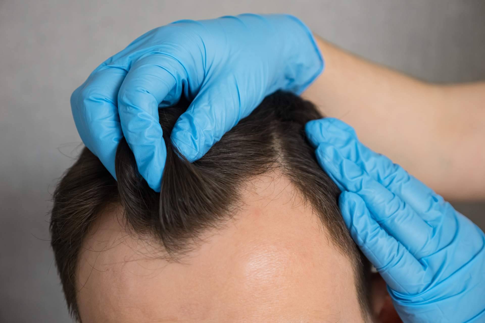 Clínica Capilar Mora abre últimas plazas para cirugía de trasplante capilar con resultados naturales
